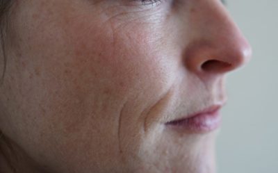 Pigmentvlek Verwijderen Ervaring
