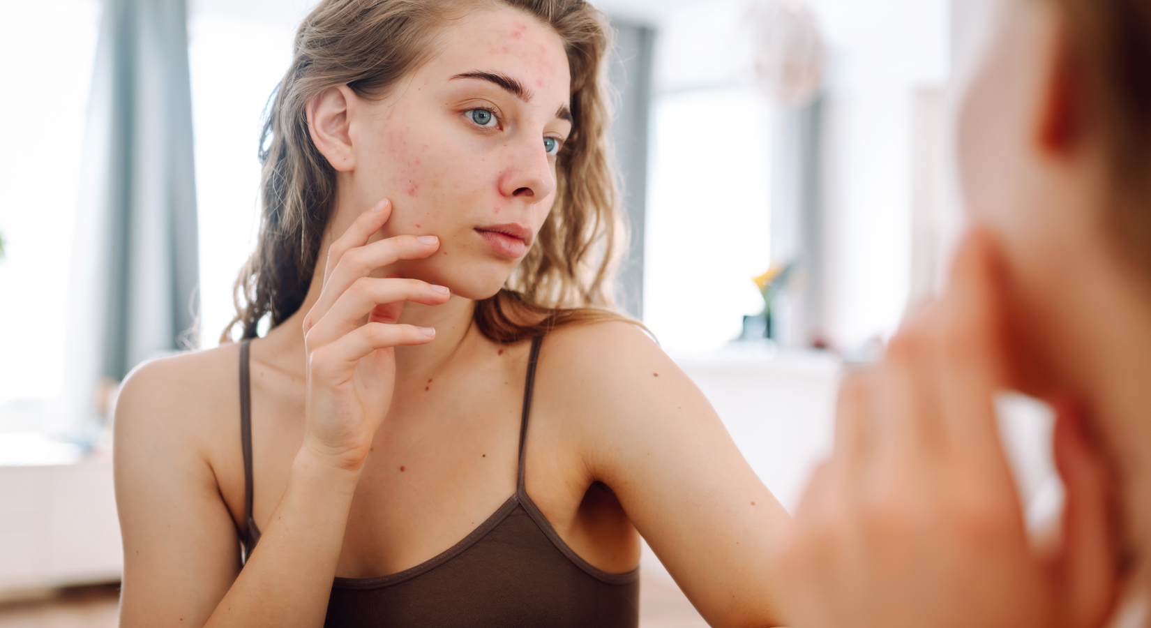 De Meest Voorkomende Oorzaken Van Acne Op Een Rijtje