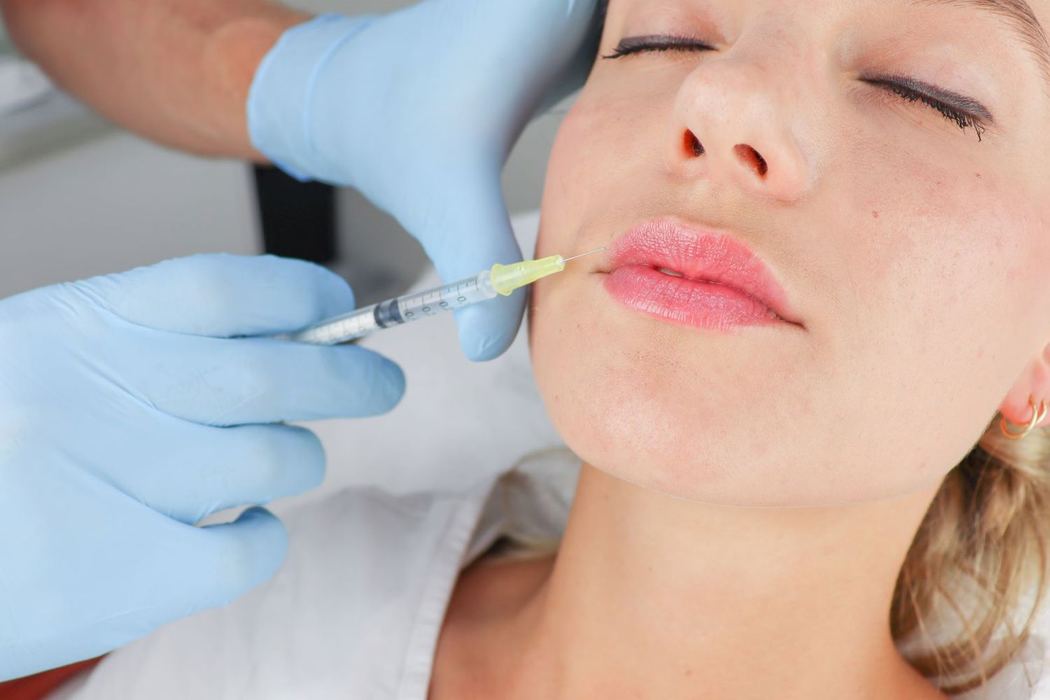 Lipfillers Injectables