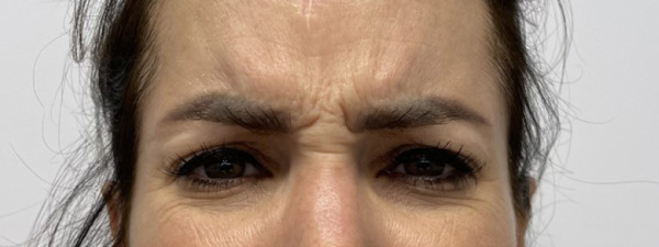 Botox Frons