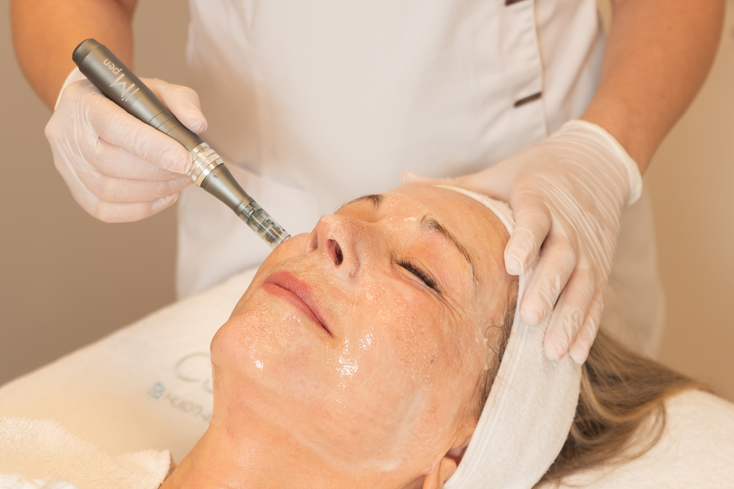 Microneedling Behandeling Bij Cosmetique Totale (1)