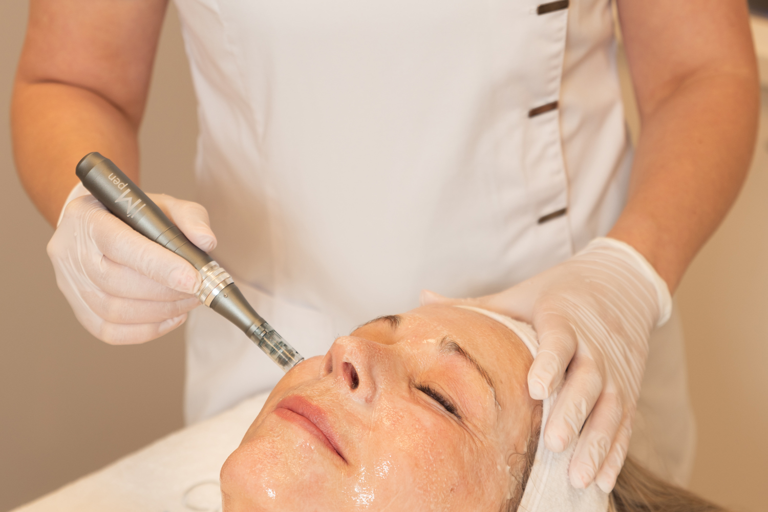 Microneedling Behandeling Bij Cosmetique Totale (1)