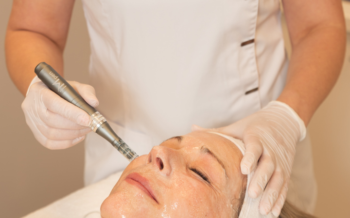 Microneedling behandeling van het gezicht bij Cosmetique Totale Antwerpen