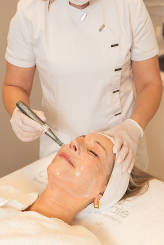 Microneedling Behandeling Bij Cosmetique Totale (1)