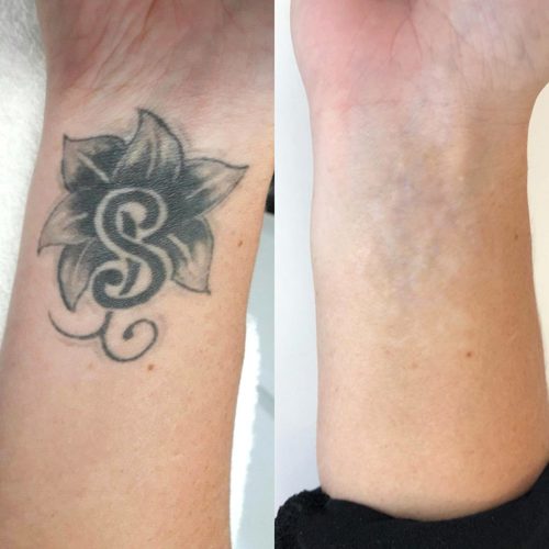 Ervaring Tatoeage Verwijderen