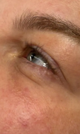 Total Eye Result 2 Before