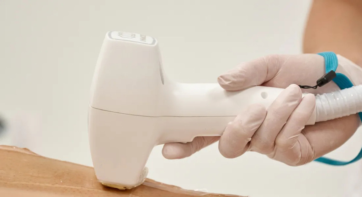 Épilation laser du SIF une méthode rapide, efficace et indolore