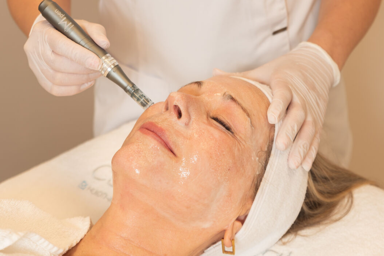 Microneedling Voor Huidverjonging