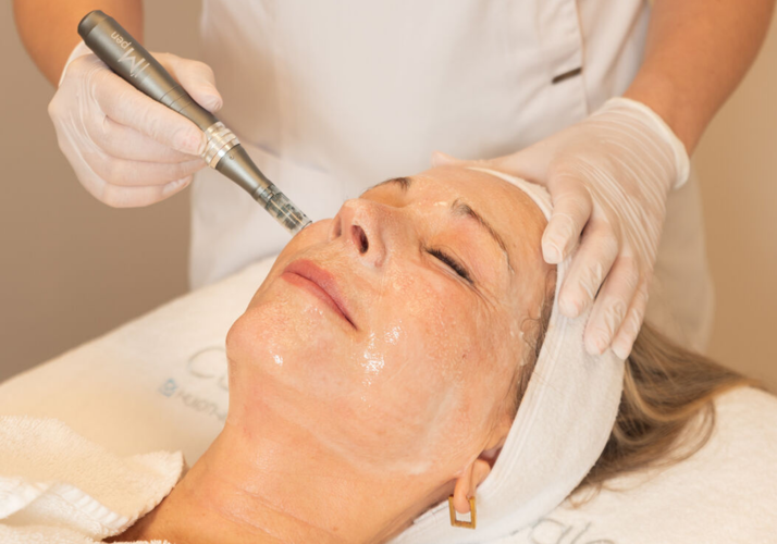 Microneedling behandeling door ervaren huidexpert bij Cosmetique Totale