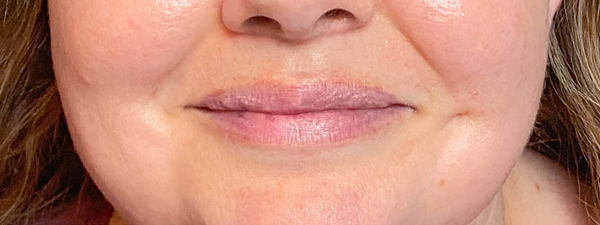 Lipfillers 42