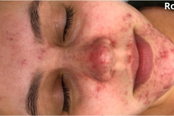 Rougeurs sur votre visage | Rosacée & couperose