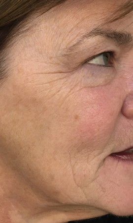 Resultaat Huidverstrakking 3