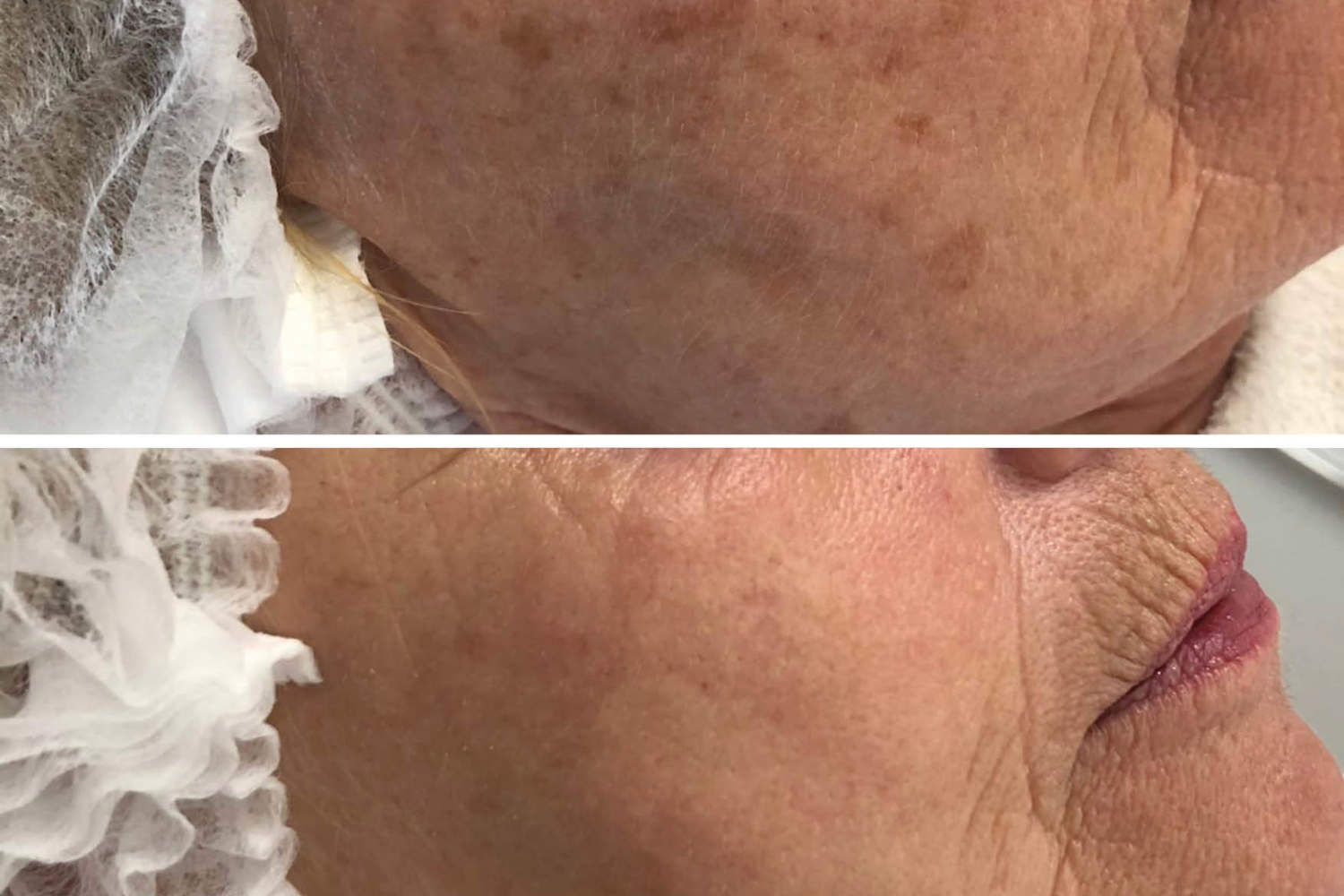 Pigmentvlekken laseren Resultaat