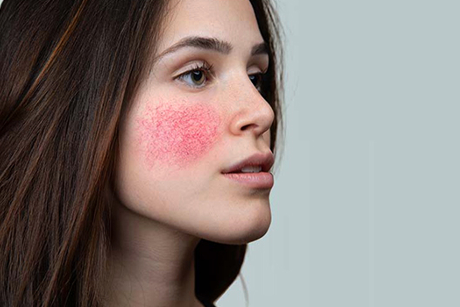 Couperose Behandeling