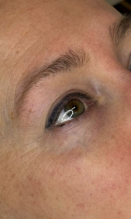 Microneedling Rondom Ogen Resultaat 2