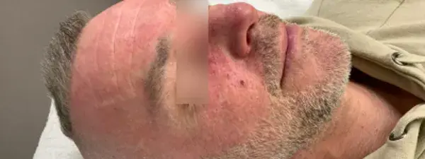 Resultaat Rosacea Behandeling 1