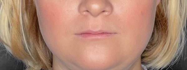 Lipfillers 3 (1)