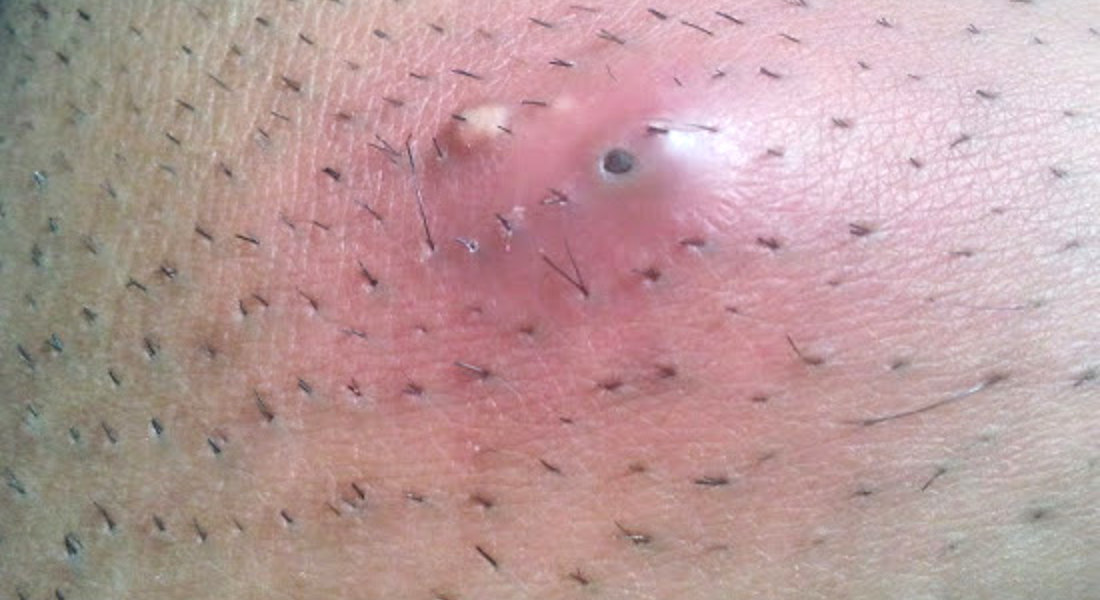 Follicules pileux enflammés et poils incarnés