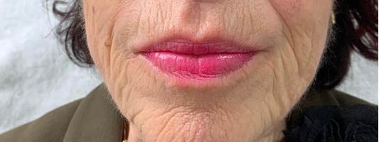 Huidverjonging laserbehandeling | Cosmetique Totale.