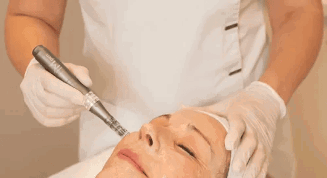 Medical Microneedling Berlin (2)
