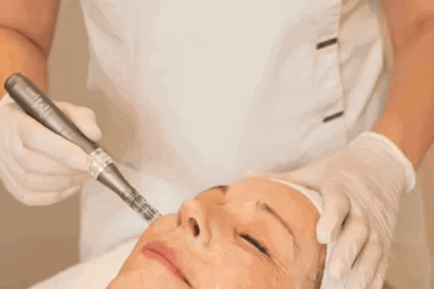 Medical Microneedling Berlin (2)