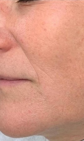 Resultaat Rimpelbehandeling Na 1