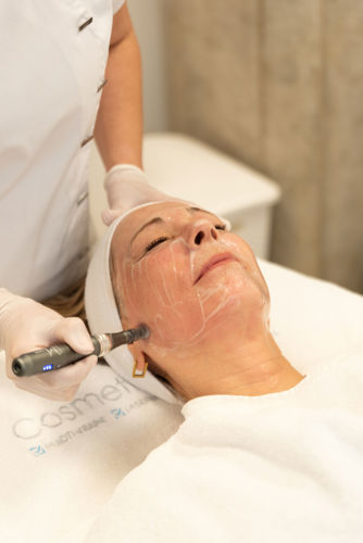 Microneedling Bennekom