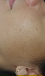 Résultat Cicatrices D'acne 22