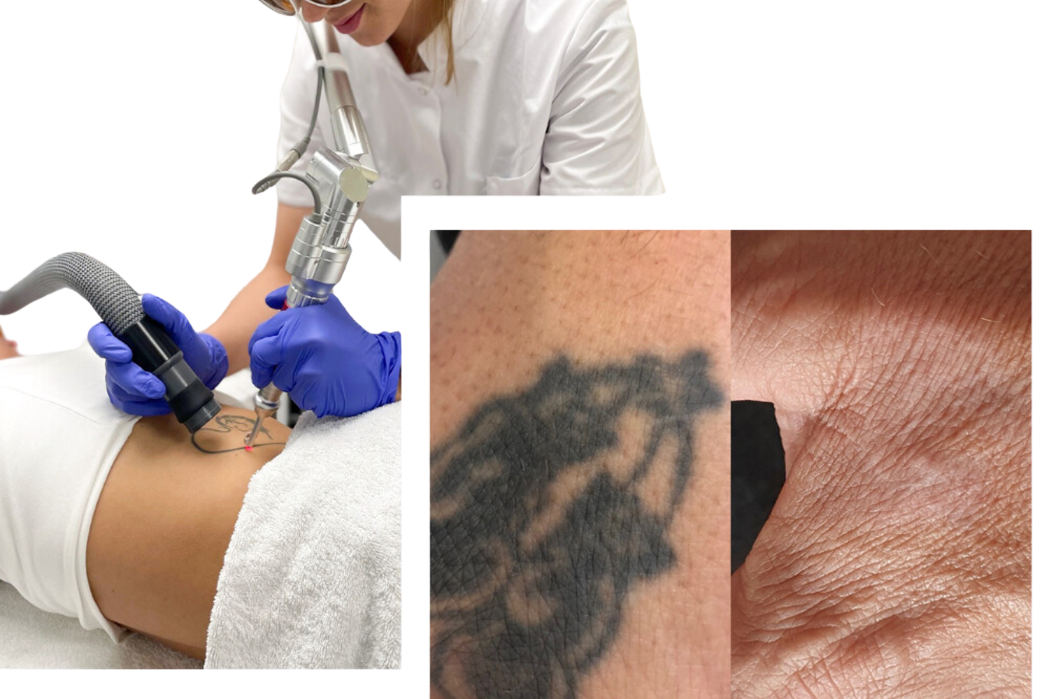 Tatoeage Laseren NRC (2)