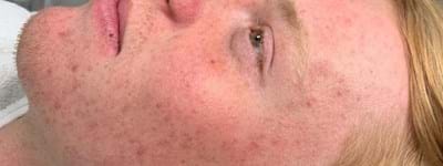 Résultat D'acne 32