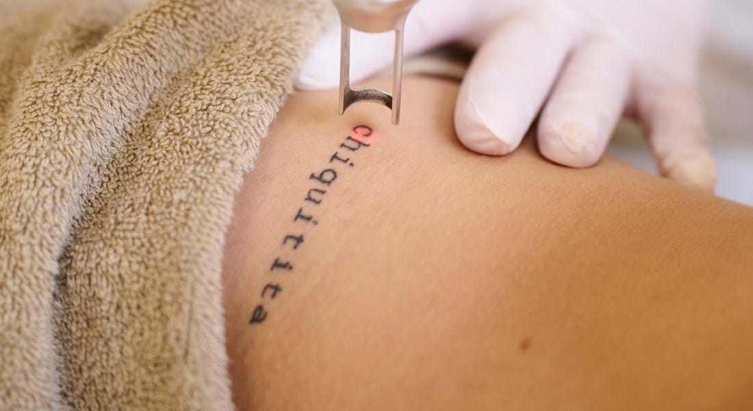 Tattoo Verwijderen Emmen