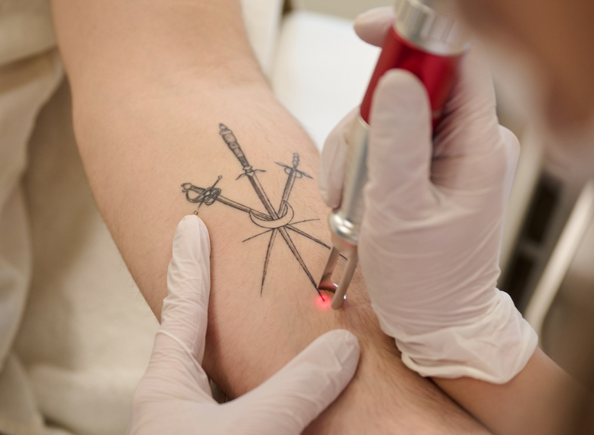 Tattoo Laseren Mannen (1)
