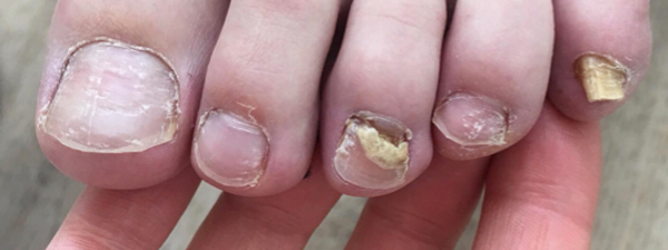 Traitement Mycose De L'ongle 2