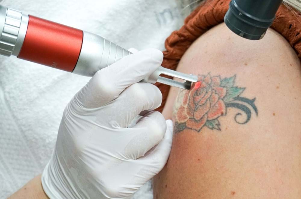 Tattoo Verwijderen Rotterdam