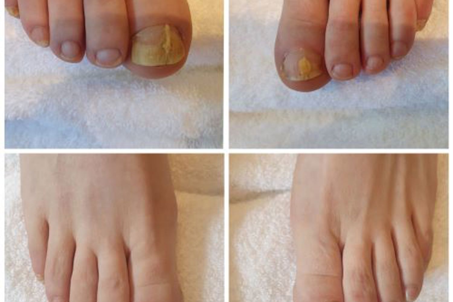 Kalknagels Laserbehandeling 2