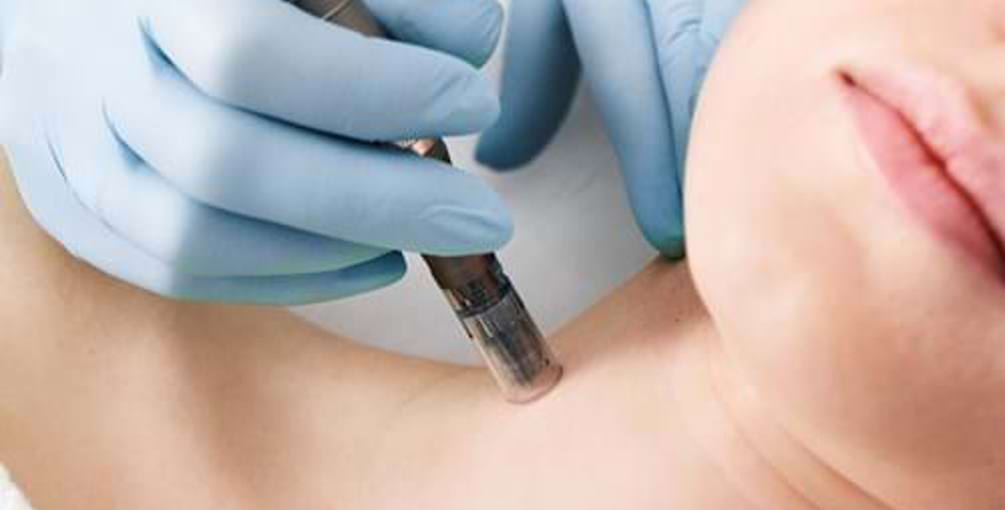 Traitement De Microneedling