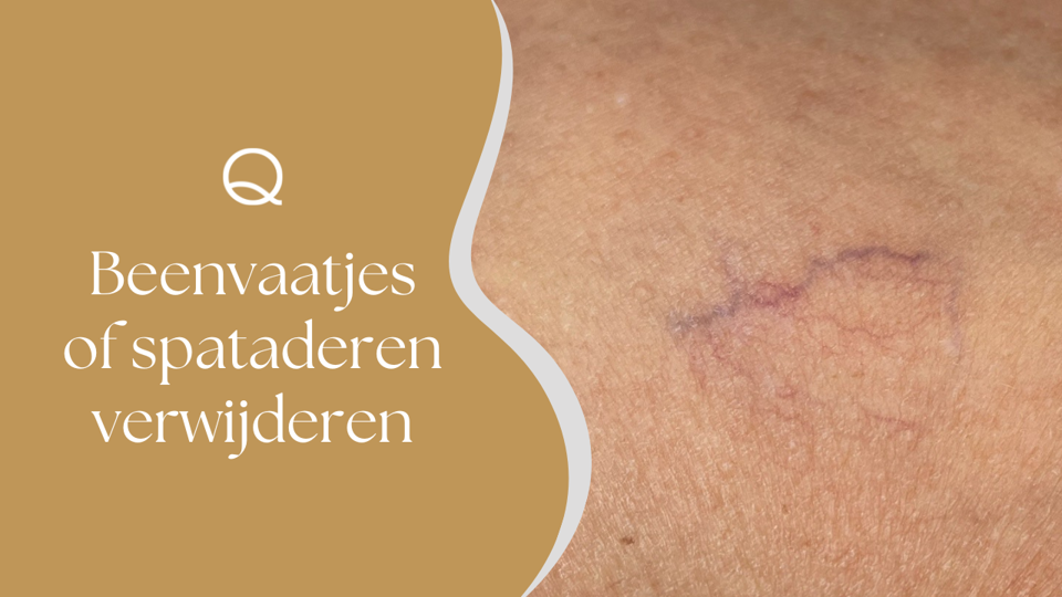 Beenvaatjes Of Spataderen Verwijderen