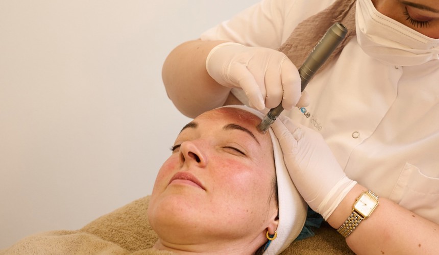 Microneedling Nijmegen Oost
