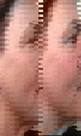 Hautverjüngung Ergebnis 2