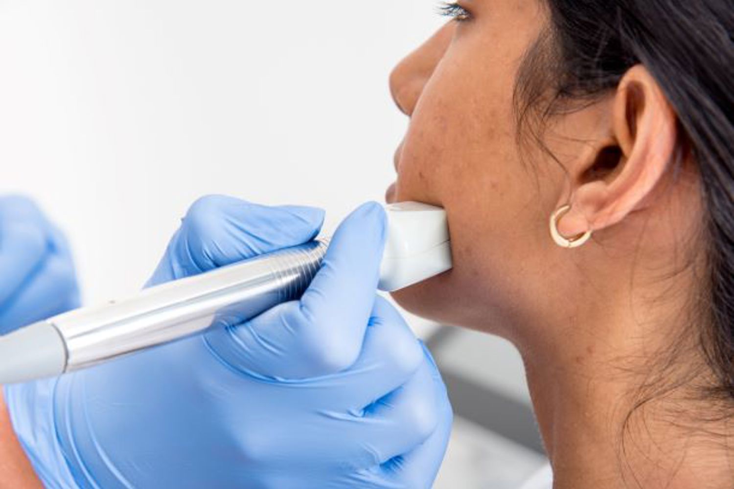 Acne Littekens Vergoeding