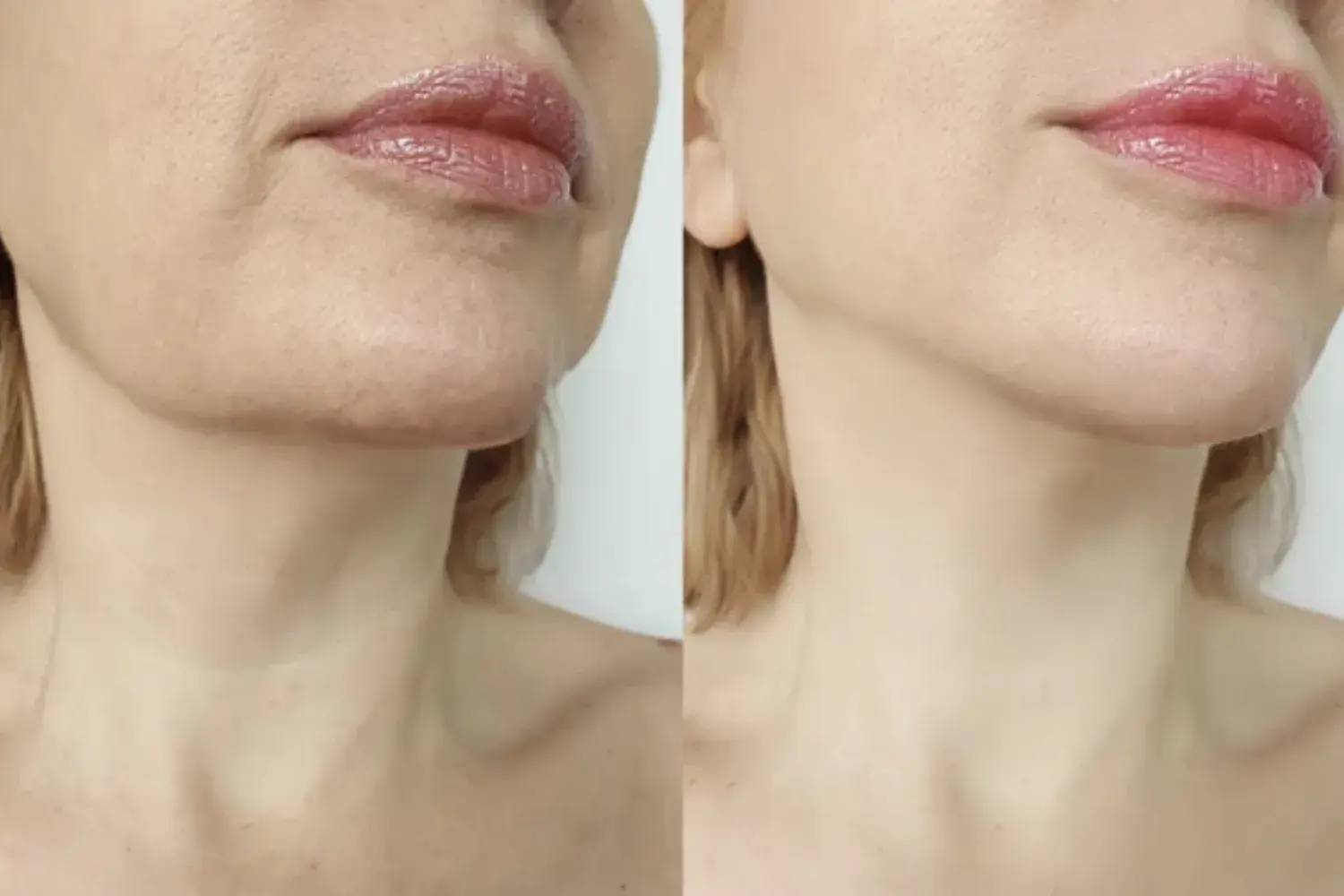 Quels Fillers Sont Utilisés ?