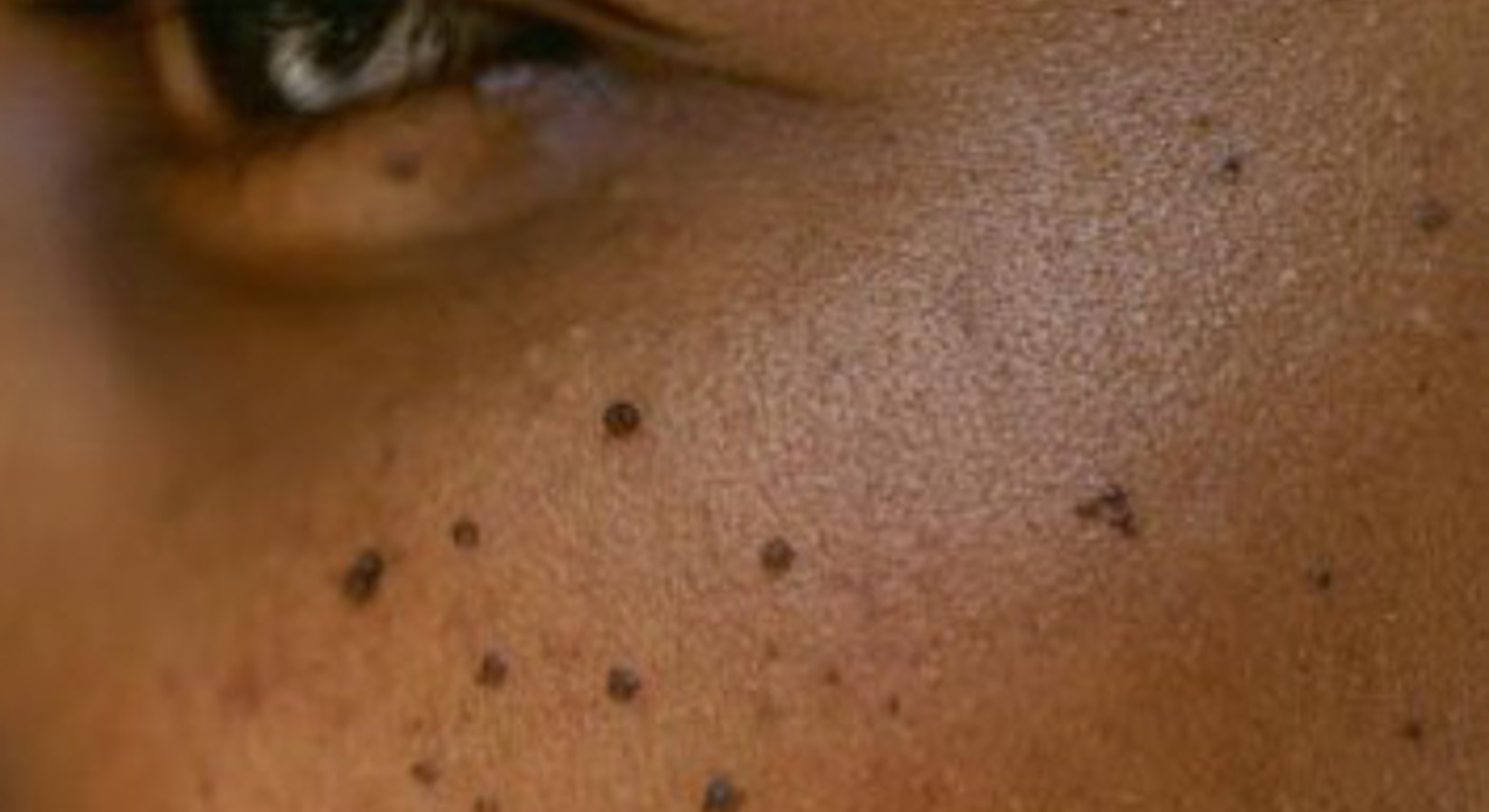 Dermatosis Papulosa Nigra Zwarte Huidbultjes