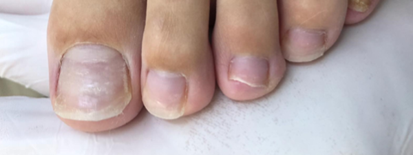 Traitement Mycose De L'ongle 22