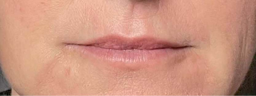 Lipfillers 42 (1)