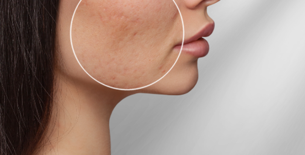 Acne Littekens Wat Zijn Het En Hoe Kom Ik Er Va Af (1)