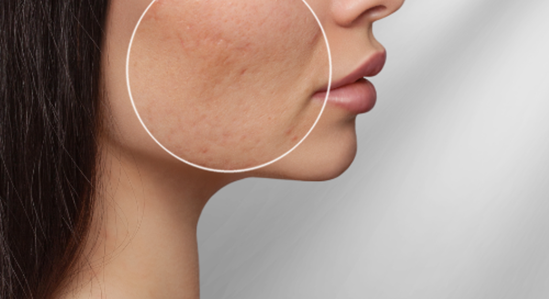Acne Littekens Wat Zijn Het En Hoe Kom Ik Er Va Af (1)