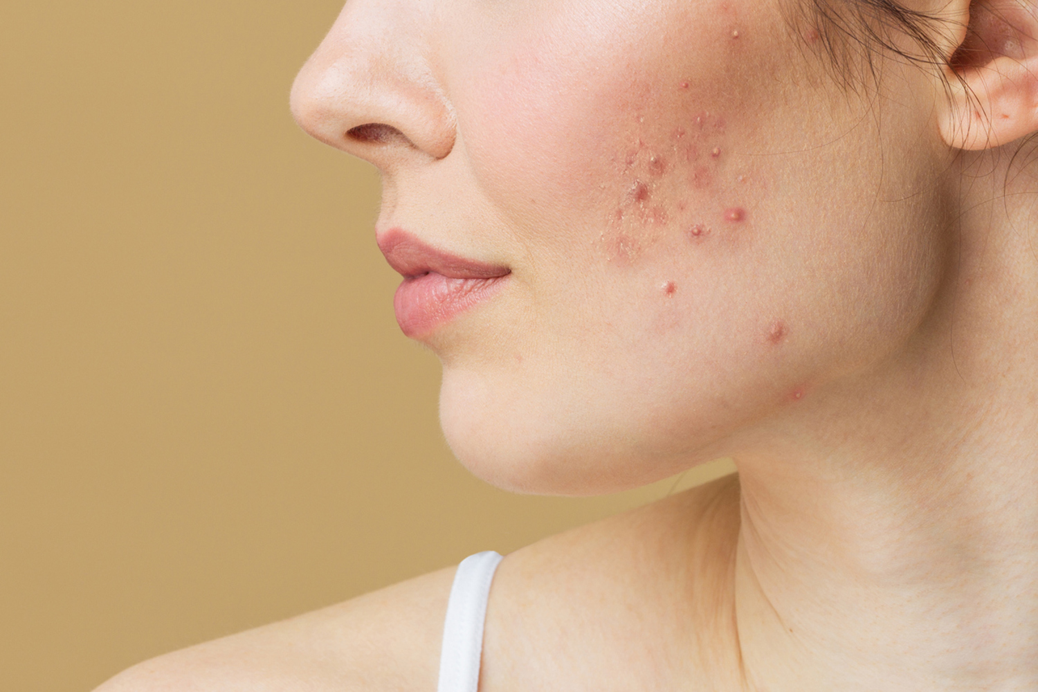 Wanneer Kan Je Een Medische Behandeling Ondergaan Acne