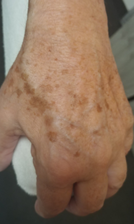 Taches Pigmentaires Mains 1