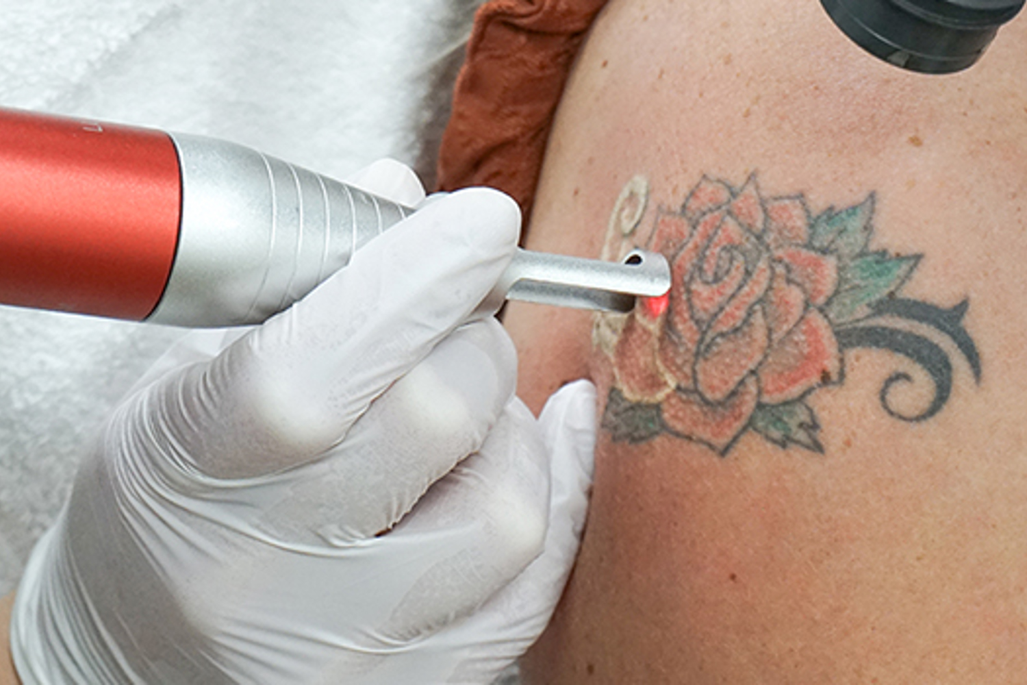 Tattoo Verwijderen Assen