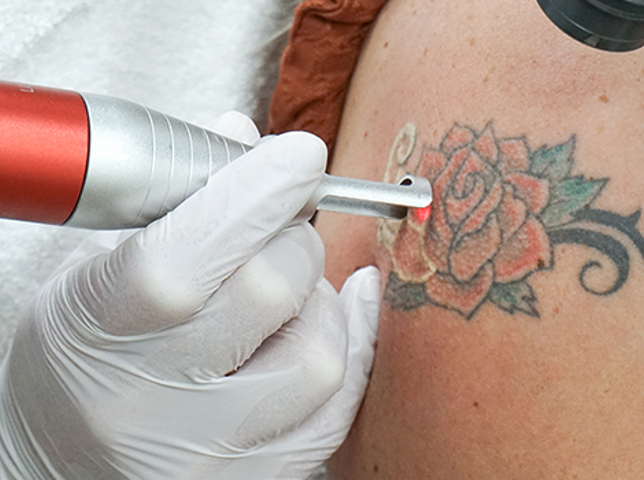 Tattoo Verwijderen Assen